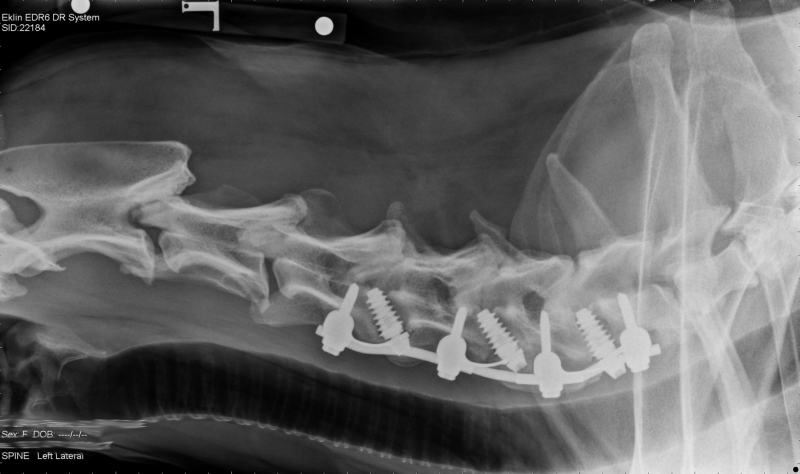 Post-surgery radiograph showing distraction fusion implants at the base of the cervical spine.
