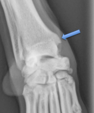 Example of Abductor Pollicus Longus Tenosynovitis