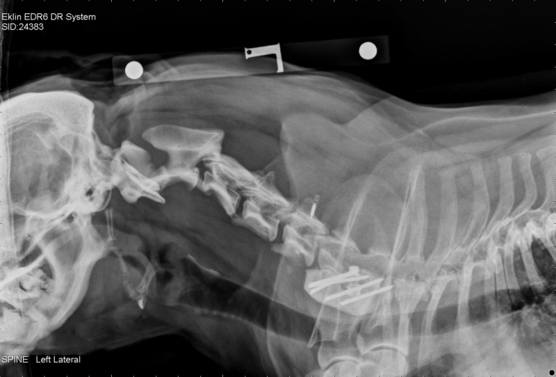 Emily's post-surgery radiograph showing the spinal implants in place.