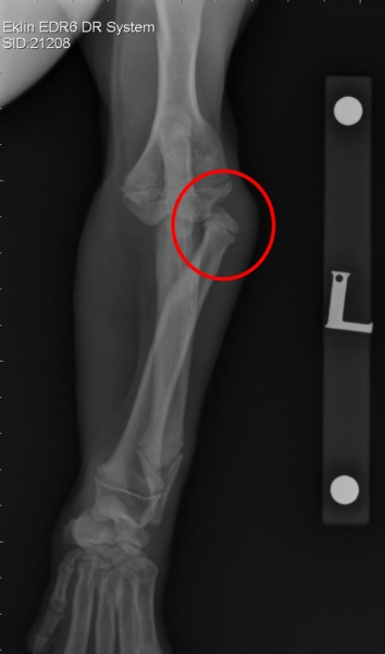 Radiograph showing Jasper's luxated radial head