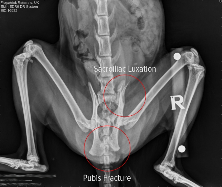 Radiograph showing Lolli's pelvic fractures.